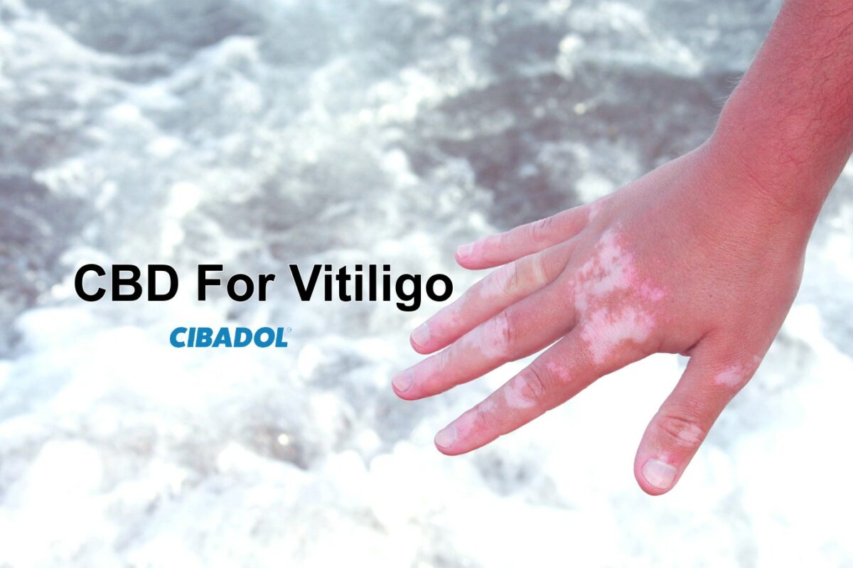 CBD For Vitiligo