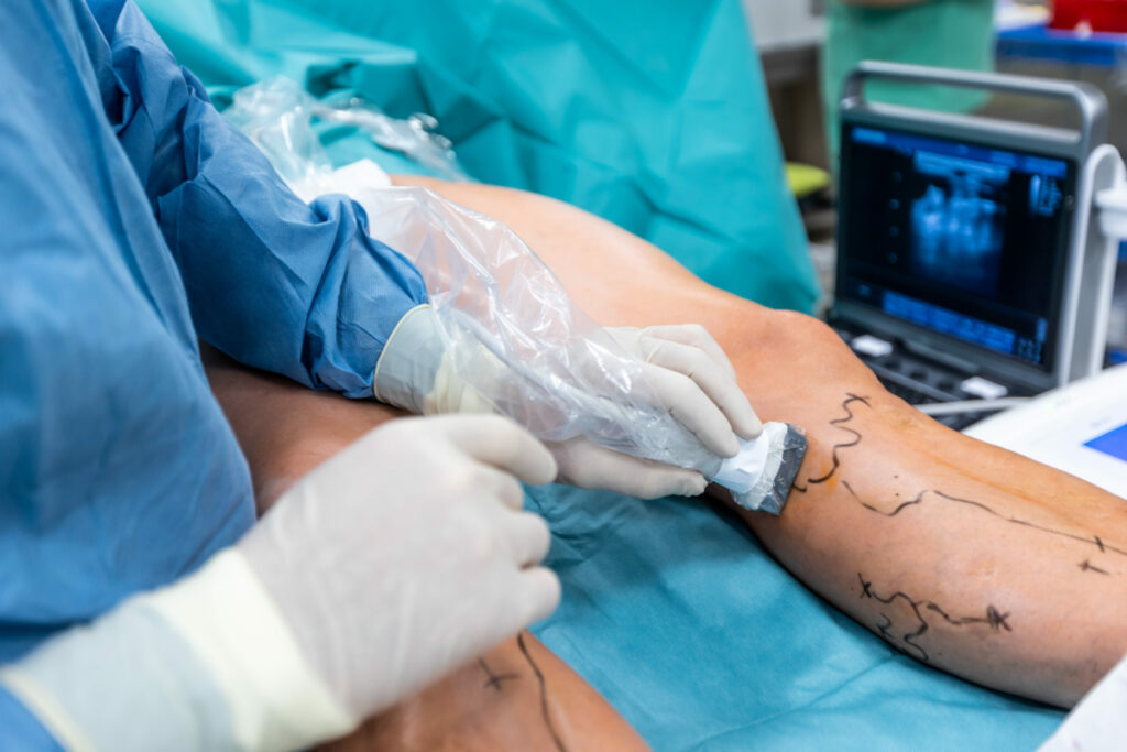 CBD And Varicose Veins