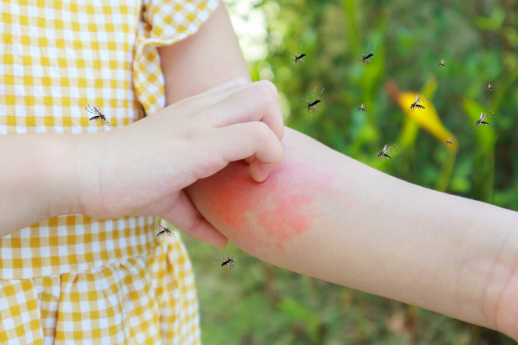 CBD Oil For Mosquito Bites